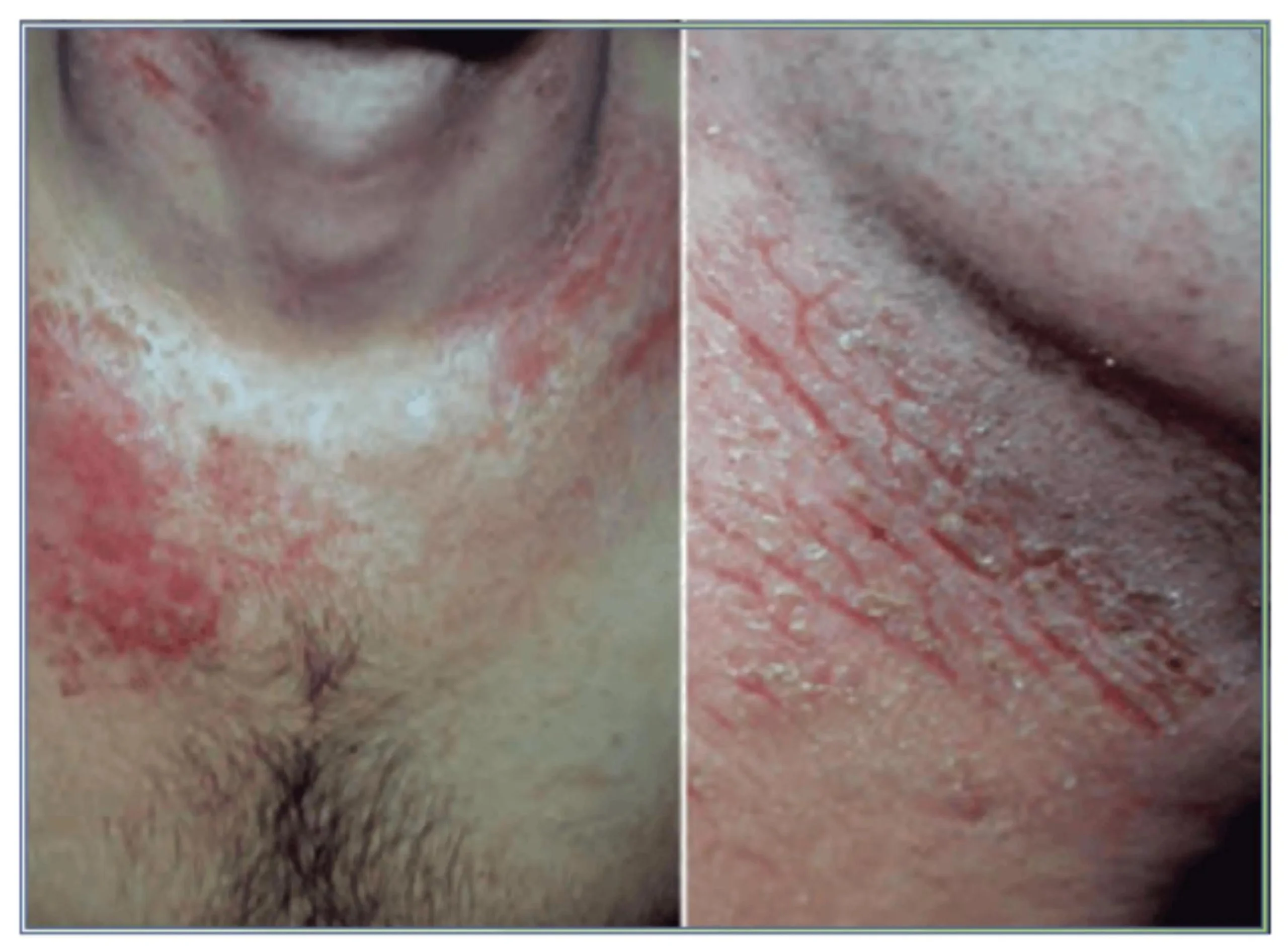 Dermatosis Mecánicas: Causas, Síntomas y Tratamiento - Cuál es la causa de las dermatosis dermatrosis mecanico - Cuál es la causa de las dermatosis